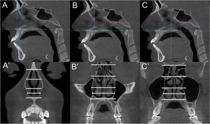 Dimensional changes of upper airway after slow vs rapid miniscrew-supported  maxillary expansion in adolescents: a cone-beam computed tomography study, BMC Oral Health