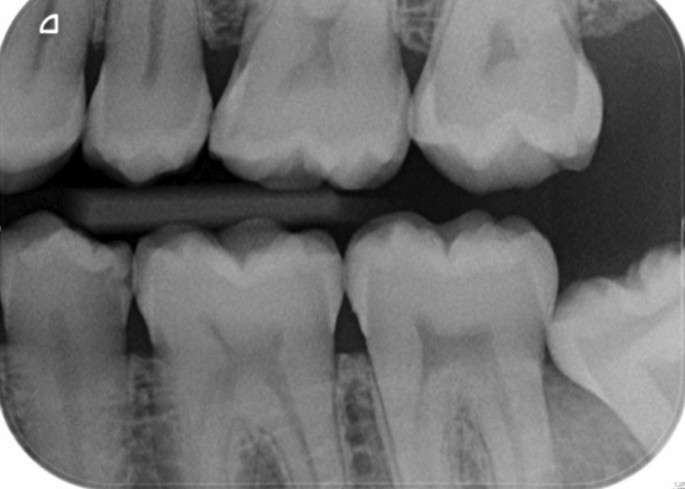 Mean scores for dental caries in the mandibu- lar molars of each group.