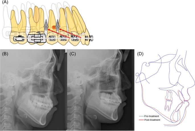 PDF) Changes in the anterior and posterior occlusal plane in nongrowing  females with hyperdivergent skeletal Class II malocclusion treated with mini-implant  anchorage