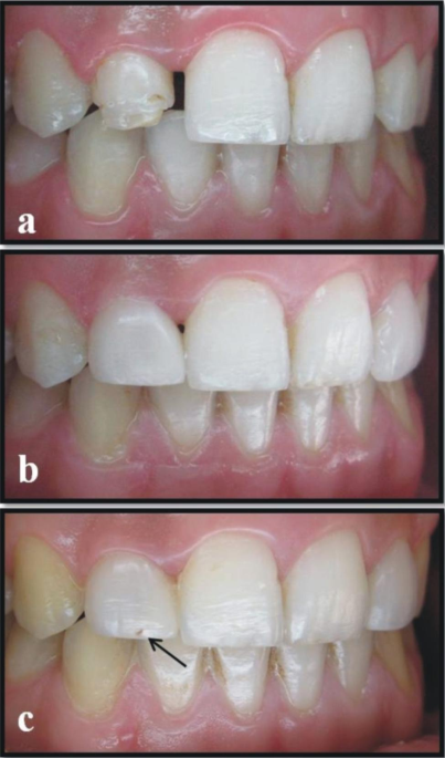 Clinical survival of No-prep indirect composite laminate veneers: a 7-year  prospective case series study | BMC Oral Health | Full Text