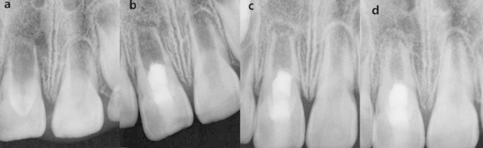 A) Preoperative periapical radiograph of tooth #21. Note the