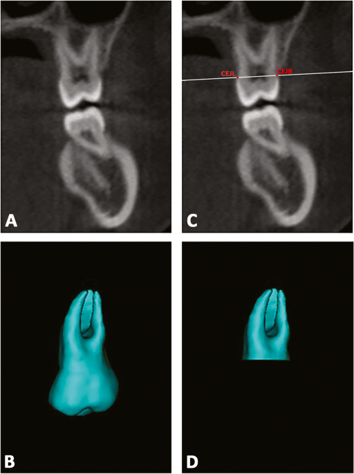 External root resorption and rapid maxillary expansion in the short-term: a  CBCT comparative study between tooth-borne and bone-borne appliances, using  3D imaging digital technology, BMC Oral Health