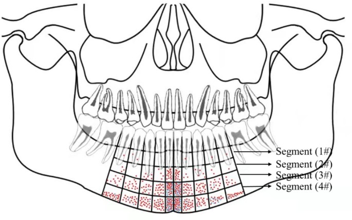 Dental implants: Mandibular neurovascular considerations 