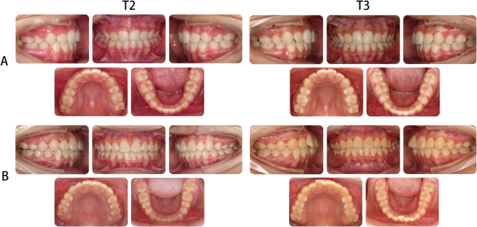 Analysis of predictive factors for post orthodontic stability a  