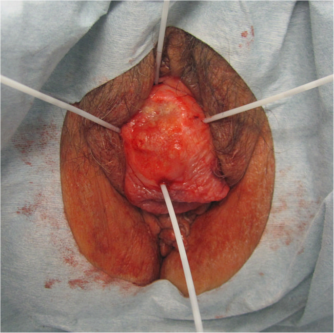 Radiation therapy for vaginal cancer in complete uterine prolapse with  intrauterine adhesion: a case report, BMC Women's Health