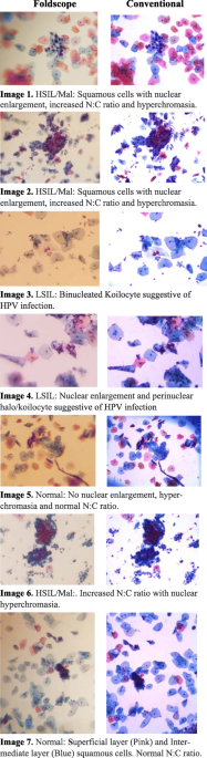 Evaluating the performance of a low-cost mobile phone attachable microscope  in cervical cytology | BMC Women's Health | Full Text