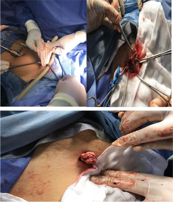 Laparoscopic Resection of an Epidermal Inclusion Cyst at the