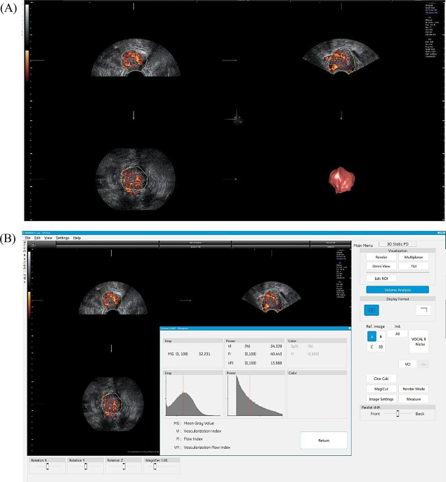 Based on 3D-PDU and clinical characteristics nomogram for prediction of lymph node metastasis and lymph-vascular space invasion of early cervical cancer preoperatively