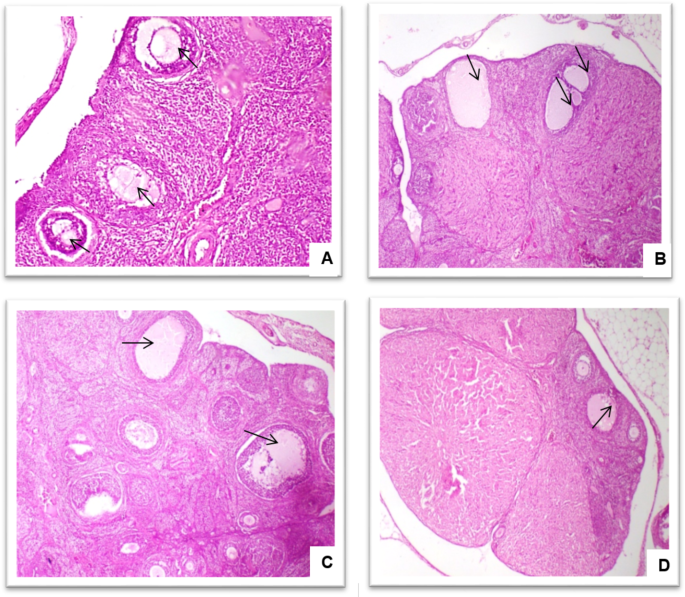 polycystic ovaries glutathione Exploring the therapeutic potential of marjoram (Origanum majorana L.) in polycystic  ovary syndrome: insights from serum metabolomics, network pharmacology and  experimental validation | BMC Complementary Medicine and Therapies