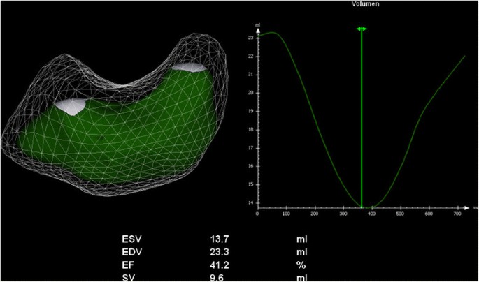 Right ventricle /LV/band models at end-ejection (minimum RV volume