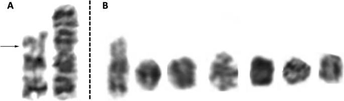 Small supernumerary marker chromosome - Wikipedia