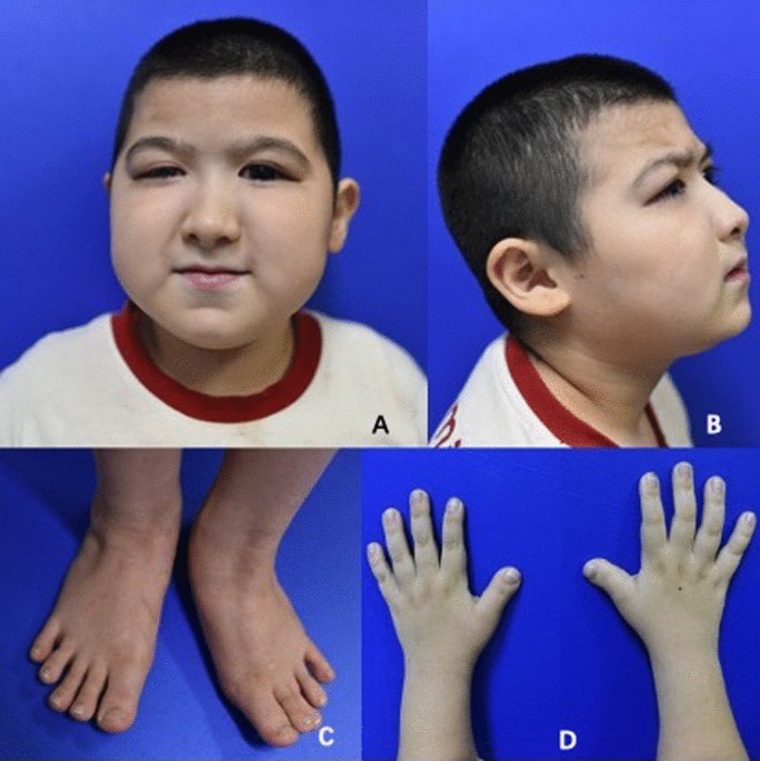 Rubinstein-Taybi syndrome (broad thumb-hallux syndrome)
