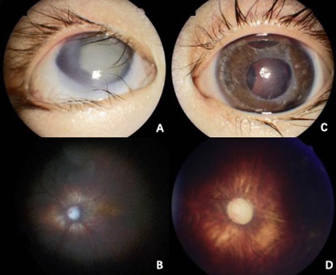 A novel CREBBP mutation and its phenotype in a case of Rubinstein–Taybi  syndrome, BMC Medical Genomics