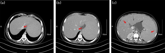 Niemann-Pick. HRCT at the level of the lower lobes shows intense and