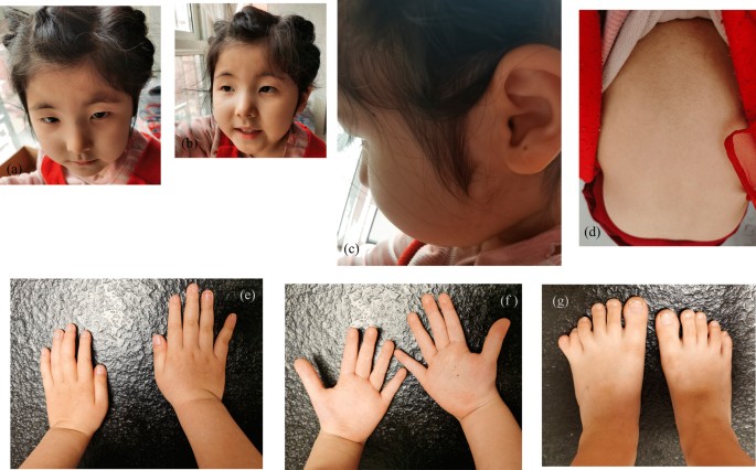 Case report: a Chinese girl like atypical Rubinstein–Taybi syndrome caused  by a novel heterozygous mutation of the EP300 gene, BMC Medical Genomics