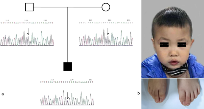 Clinical characterization of Lamb-Shaffer syndrome: a case report and  literature review | BMC Medical Genomics | Full Text