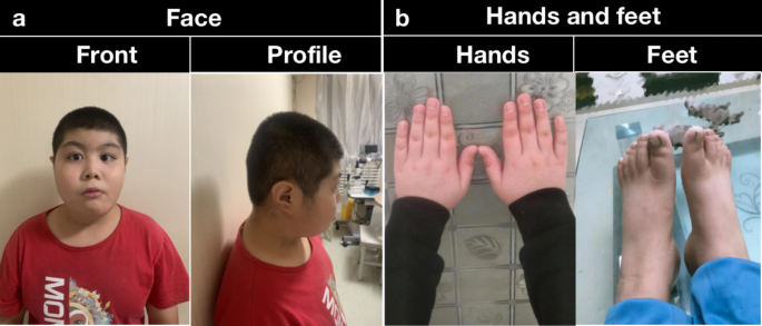 Rubinstein- Taybi Syndrome  Congenital Hand and Arm Differences