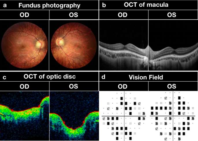 Rubinstein-Taybi Syndrome 2 disease: Malacards - Research Articles, Drugs,  Genes, Clinical Trials