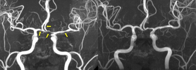 Reversible Cerebral Vasoconstriction Syndrome