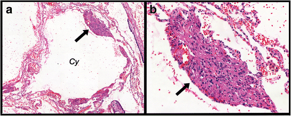 Immunohistological features related to functional impairment in  lymphangioleiomyomatosis | Respiratory Research | Full Text