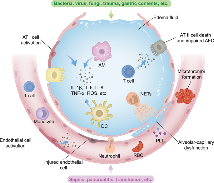 Signaling pathways and potential therapeutic targets in acute respiratory  distress syndrome (ARDS) | Respiratory Research