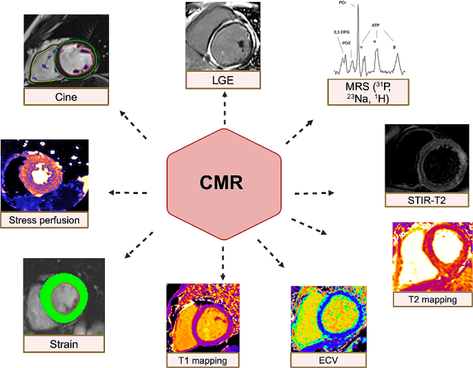Underlying mechanisms and cardioprotective effects of SGLT2i and GLP-1Ra: insights from cardiovascular magnetic resonance | Cardiovascular Diabetology