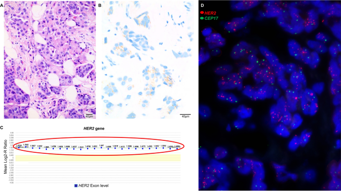 HER2 amplification by next-generation sequencing to identify HER2-positive  invasive breast cancer with negative HER2 immunohistochemistry | Cancer  Cell International | Full Text