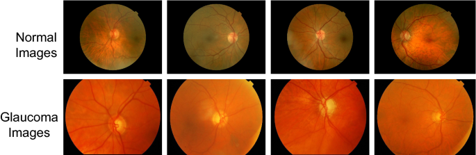 CNNs for automatic glaucoma assessment using fundus images: an extensive  validation | BioMedical Engineering OnLine | Full Text