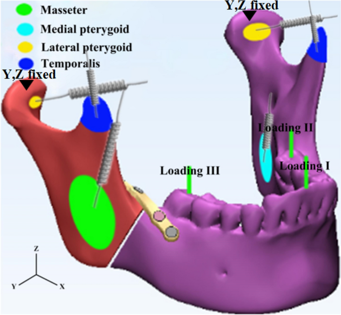 Stability of different fixation methods after reduction malarplasty under  average and maximum masticatory forces: a finite element analysis, BioMedical Engineering OnLine