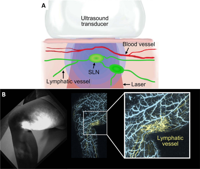 Advances in photoacoustic imaging aided by nano contrast agents: special  focus on role of lymphatic system imaging for cancer theranostics, Journal  of Nanobiotechnology
