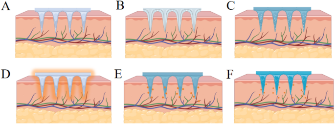 tirzepatide slimming & health nano microneedle patch Advances in microneedle-based drug delivery system for metabolic diseases:  structural considerations, design strategies, and future perspectives |  Journal of Nanobiotechnology