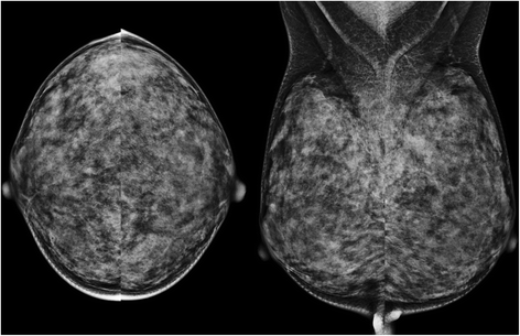 A 62-year-old woman with  non-dense  breast composition and small