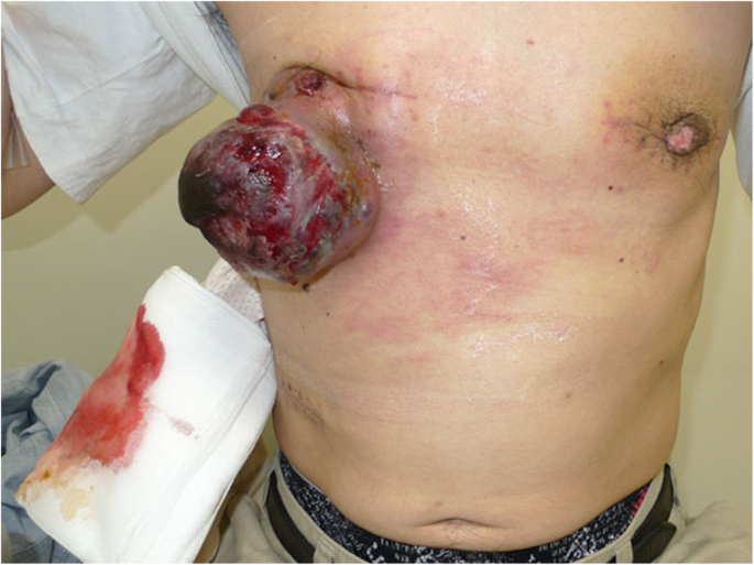 Successful pre-operative local control of skin exposure by sarcoma using  combination of systemic chemotherapy and Mohs' chemosurgery | World Journal  of Surgical Oncology | Full Text