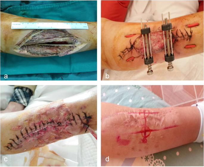 Wound Closure Techniques