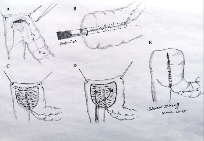 Comparison of open and intracorporeal modified ureterosigmoidostomy (Mainz  II) after laparoscopic radical cystectomy with bladder cancer | World  Journal of Surgical Oncology | Full Text