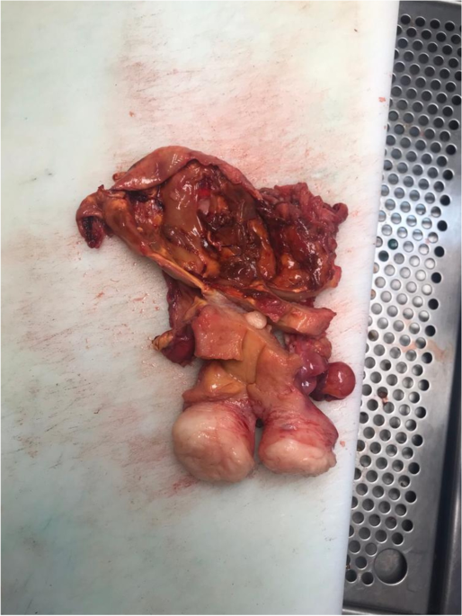 Inflammatory myofibroblastic tumour of an unusual presentation in the uterine  cervix: a case report, World Journal of Surgical Oncology