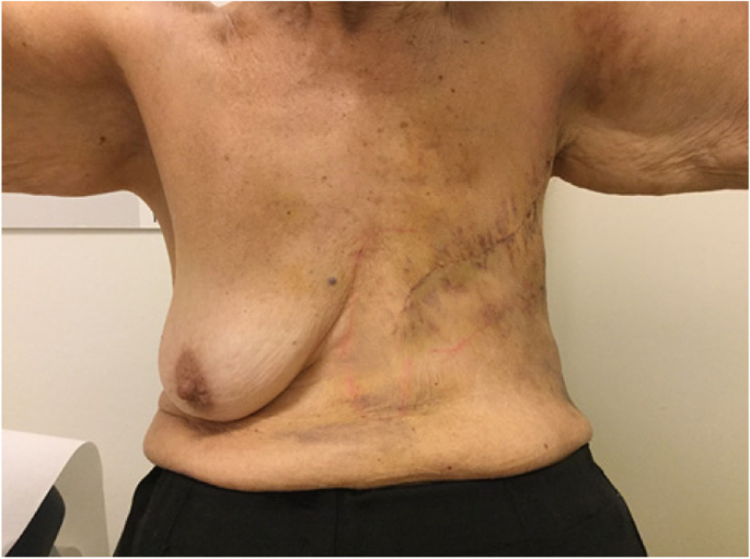 The double S technique to achieve aesthetic flat closure after conventional  mastectomy, World Journal of Surgical Oncology