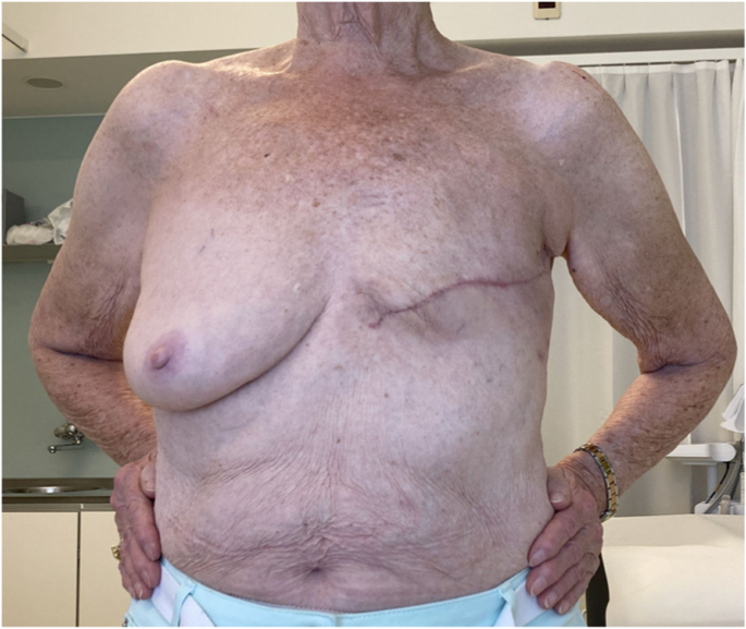 The double S technique to achieve aesthetic flat closure after conventional  mastectomy, World Journal of Surgical Oncology