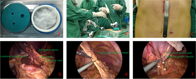 Laparoscopic gastric dissociation using a two-port approach in