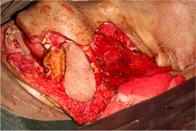 Preserving the marginal mandibular branch of the facial nerve during  submandibular region surgery: a cadaveric safety study, Patient Safety in  Surgery