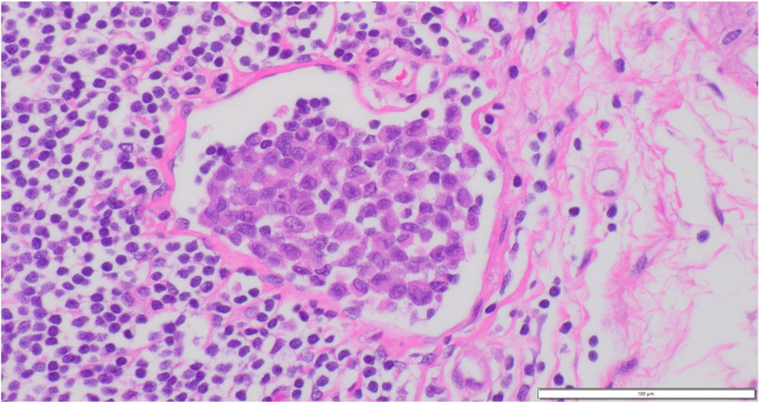 A case report of primary upper urinary tract signet-ring cell carcinoma and  literature review | BMC Urology | Full Text