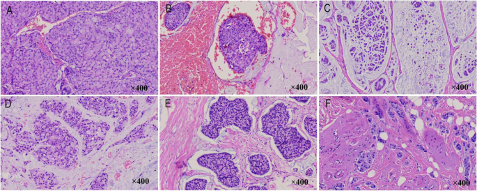 Breast metastasis of signet ring cell carcinoma from the colon: a case  report | World Journal of Surgical Oncology | Full Text