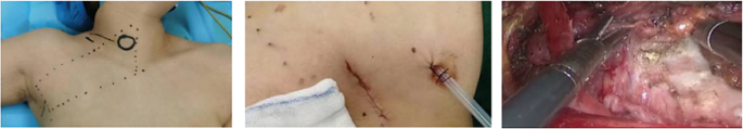 A controlled study of the hygienic technical evaluation of the transaxillary approach for inflation-free single-port lumpectomy versus conventional transcervical anterior open surgery in radical thyroid cancer resection