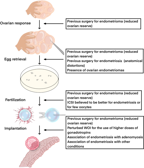 Endometriosis and IVF treatment outcomes: unpacking the process, Reproductive Biology and Endocrinology
