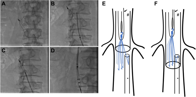 Successful retrieval of dislocated inferior vena cava filter using double  vascular sheaths docking technology: case report | Thrombosis Journal |  Full Text