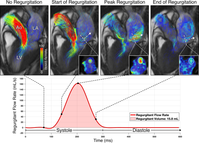 Direct mitral regurgitation quantification in hypertrophic cardiomyopathy  using 4D flow CMR jet tracking: evaluation in comparison to conventional  CMR, Journal of Cardiovascular Magnetic Resonance