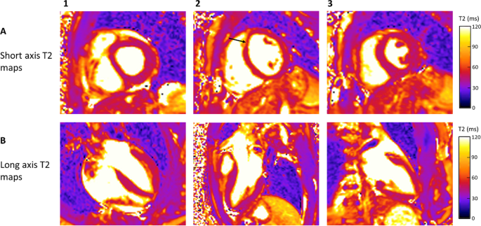 T2 Relaxation Times at Cardiac MRI in Healthy Adults: A Systematic