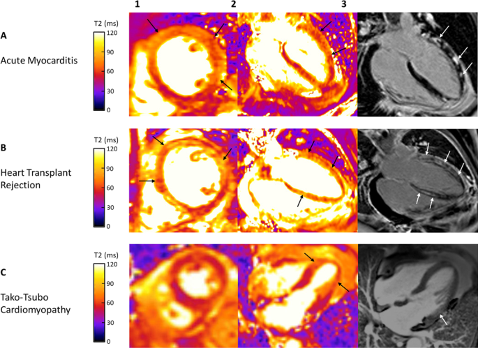 T2 Relaxation Times at Cardiac MRI in Healthy Adults: A Systematic