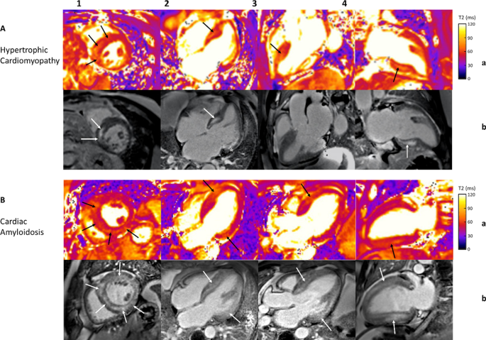 T2 Relaxation Times at Cardiac MRI in Healthy Adults: A Systematic