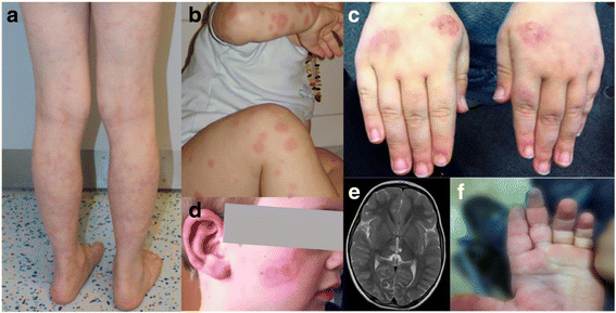 Autoimmune phenotype with type I interferon signature in two brothers with ADA2  deficiency carrying a novel CECR1 mutation | Pediatric Rheumatology | Full  Text